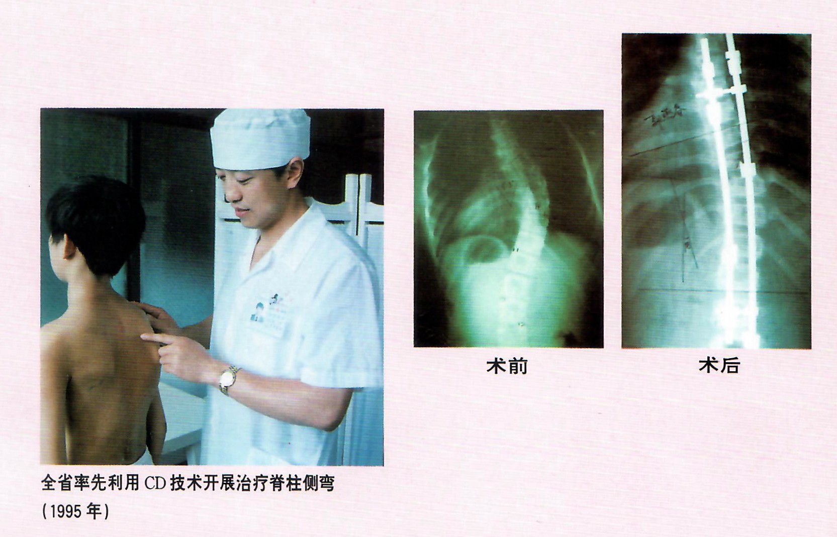 1995年，林海滨教授做了福建省第一例CD技术矫正脊椎侧弯手术.jpg